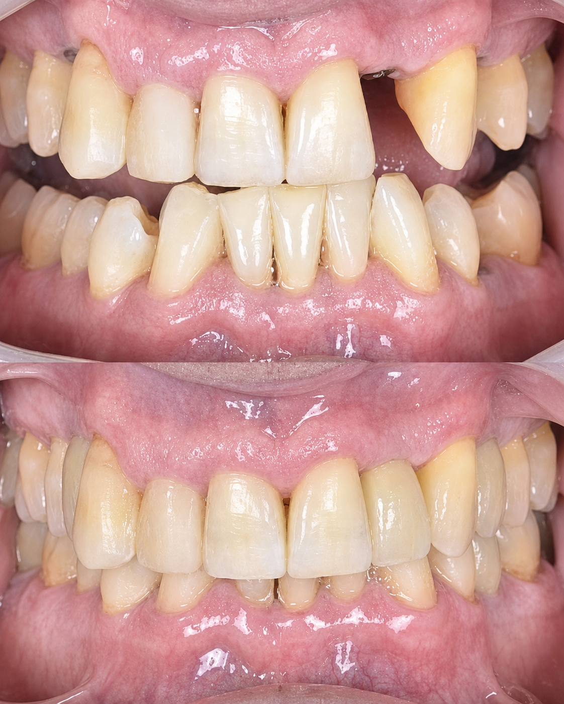 Before-and-after close-up of teeth, showing alignment and color improvement.