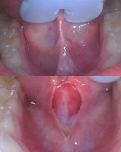 Two close-up views of a red, inflamed mouth sore on the inner lower lip/cheek.