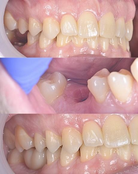 Close-up of teeth showing a misaligned canine in three dental comparison views.