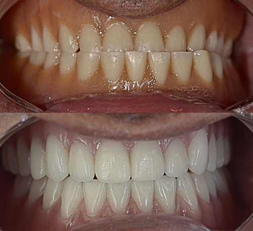 Before-and-after close-up of teeth: darker natural teeth above, whiter polished teeth below.