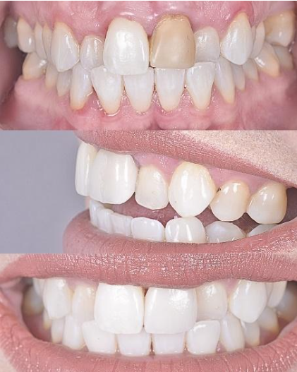 Three close-up smiles showing teeth alignment and shade differences before and after whitening