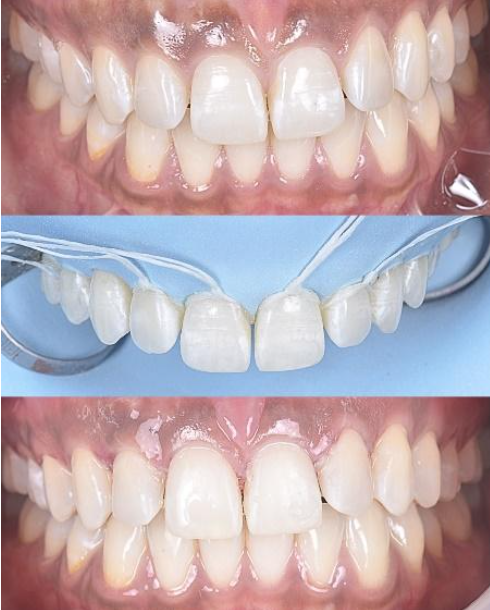 Three-panel dental close-up showing teeth before and after whitening with a whitening tray in the middle.