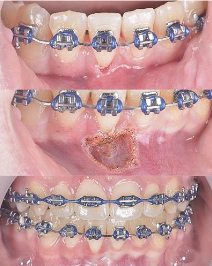 Braces on teeth in three close-up views, with a sore/ulcer visible on the gum in the middle panel