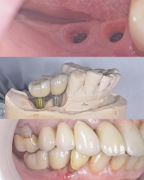 Dental implant case showing gum openings, implant model, and close-up of teeth alignment