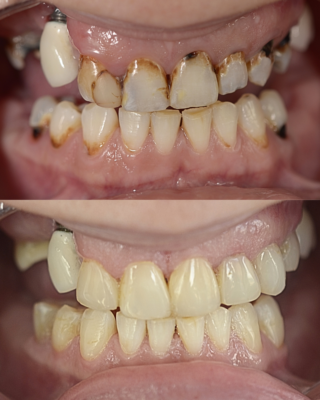 Before-and-after close-up of teeth, with heavily stained upper teeth and cleaner, whiter teeth below.