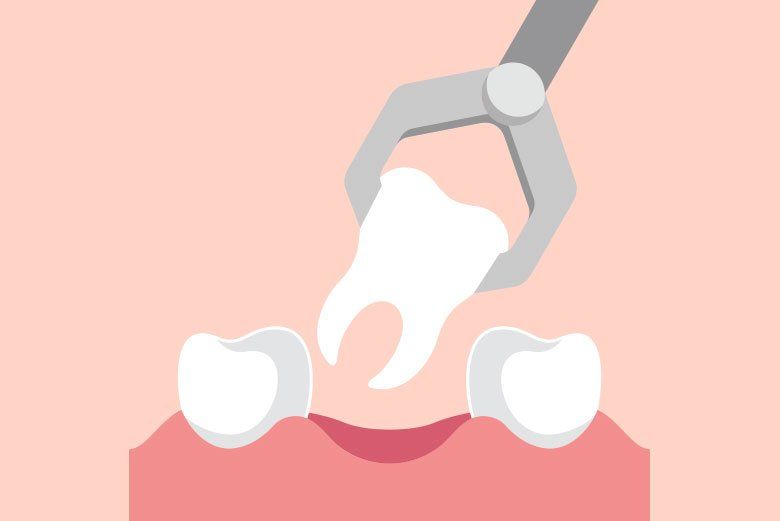 Dental tool cleaning a tooth in pink gums, with two adjacent teeth visible.