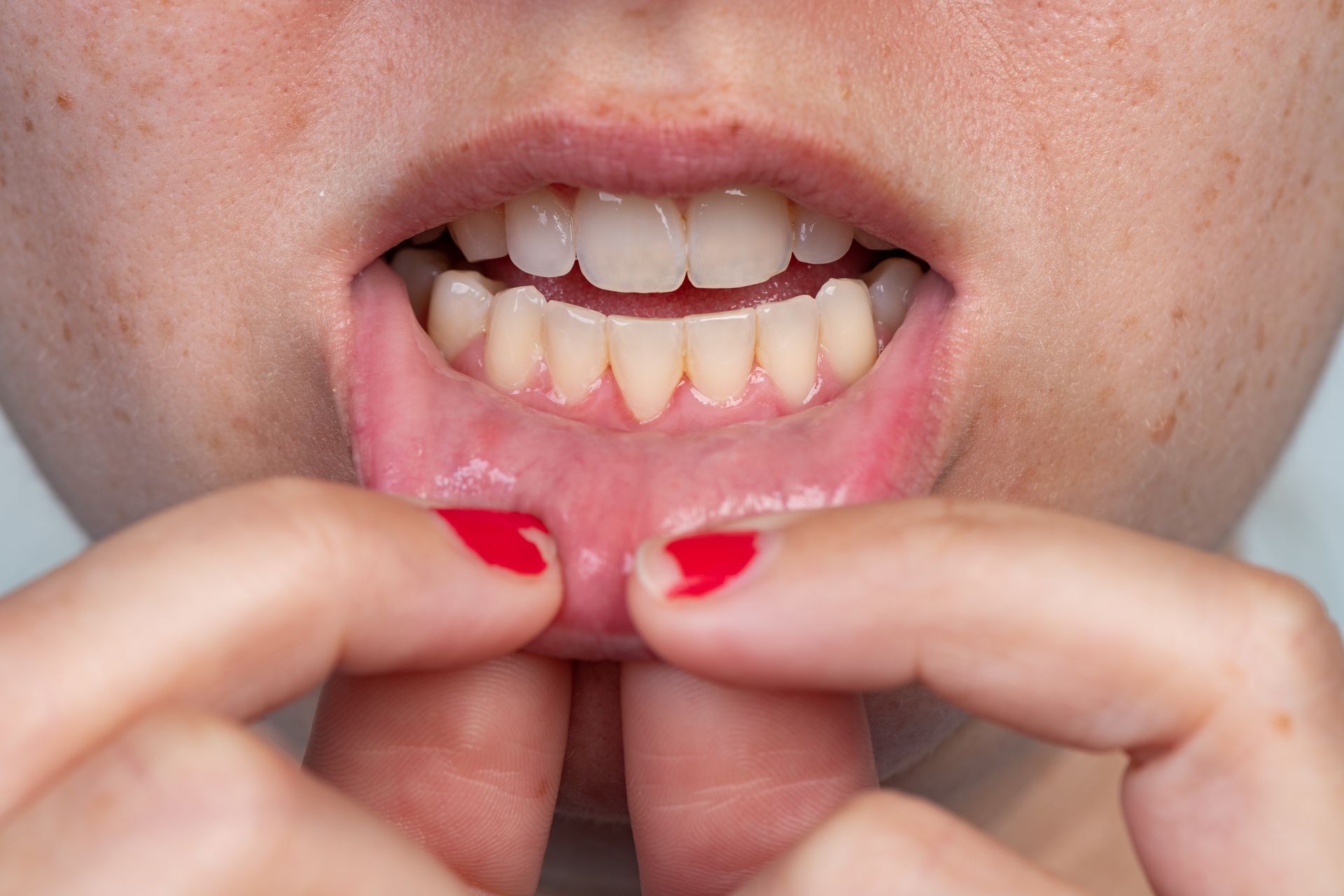 Hands holding lower lip open to show teeth and gums with red nail polish visible