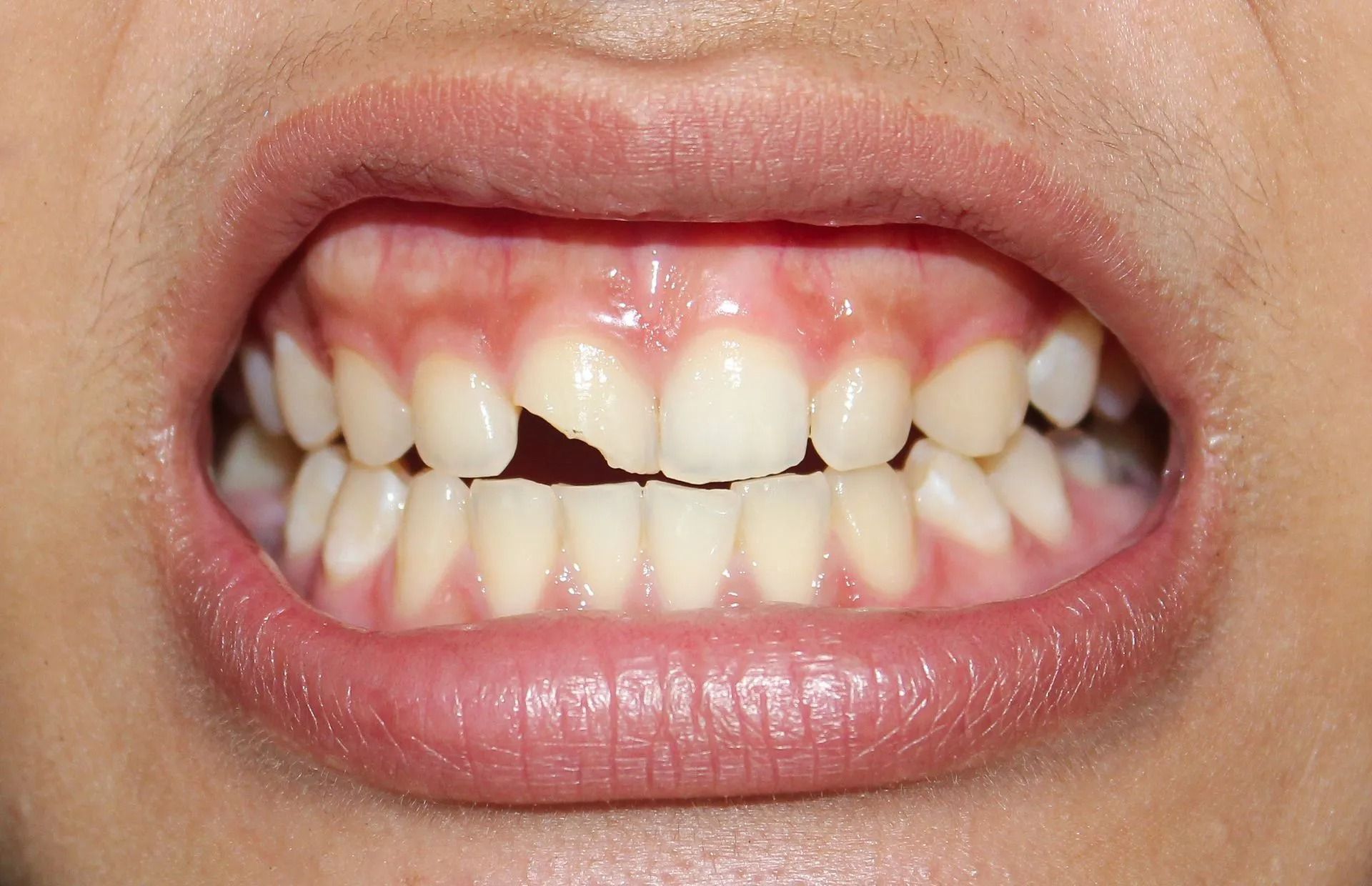 Close-up of a mouth with teeth exposed, showing a gap and pink gums