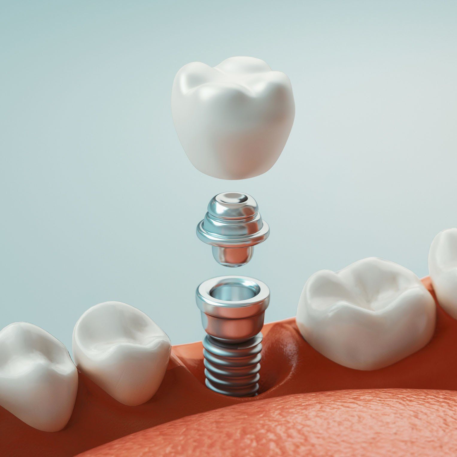Dental implant components separated: screw, abutment, and crown above gumline and adjacent teeth.