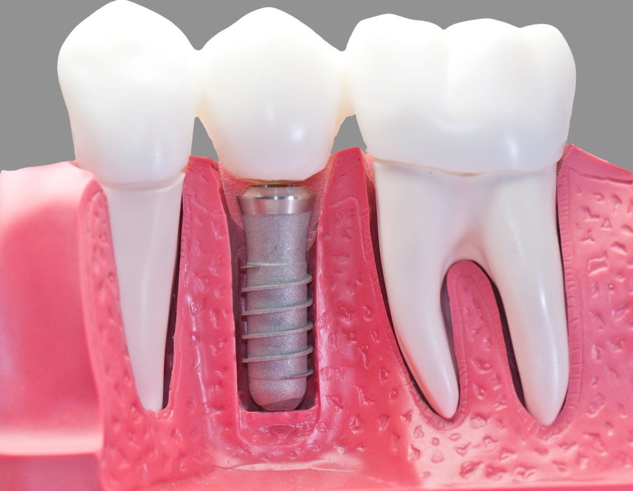 Model of dental implant and bridge, showing a screw embedded in pink gum tissue. White teeth are visible.