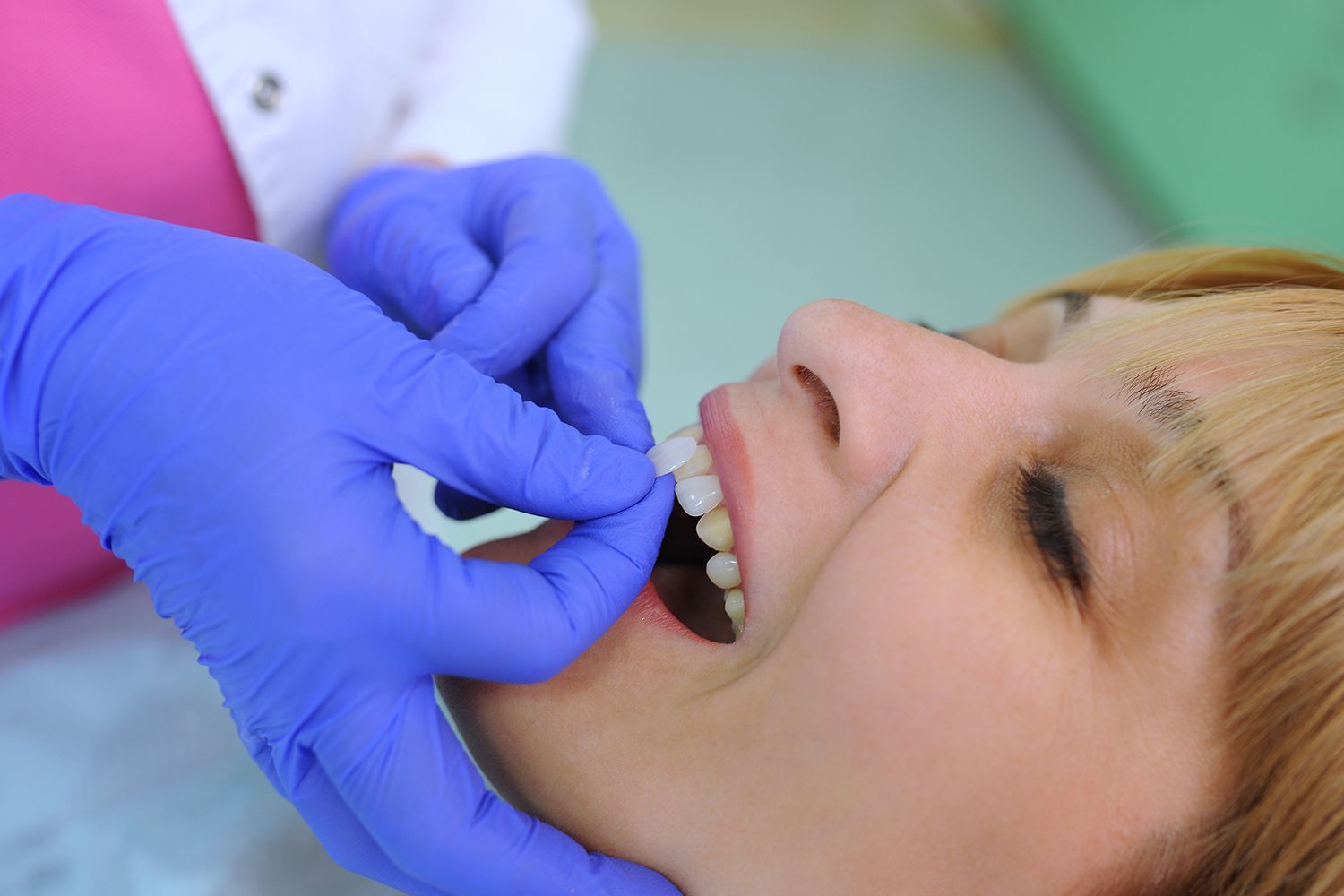 A cosmetic dentist, wearing blue gloves, tries on dental veneers on a patient for teeth correction. A cosmetic dentist, wearing blue gloves, tries on dental veneers on a patient for teeth correction.