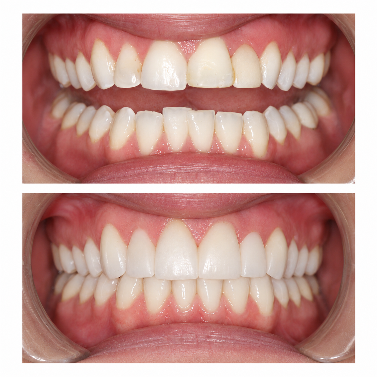 Smiling mouth with visible, white teeth and pink lips.