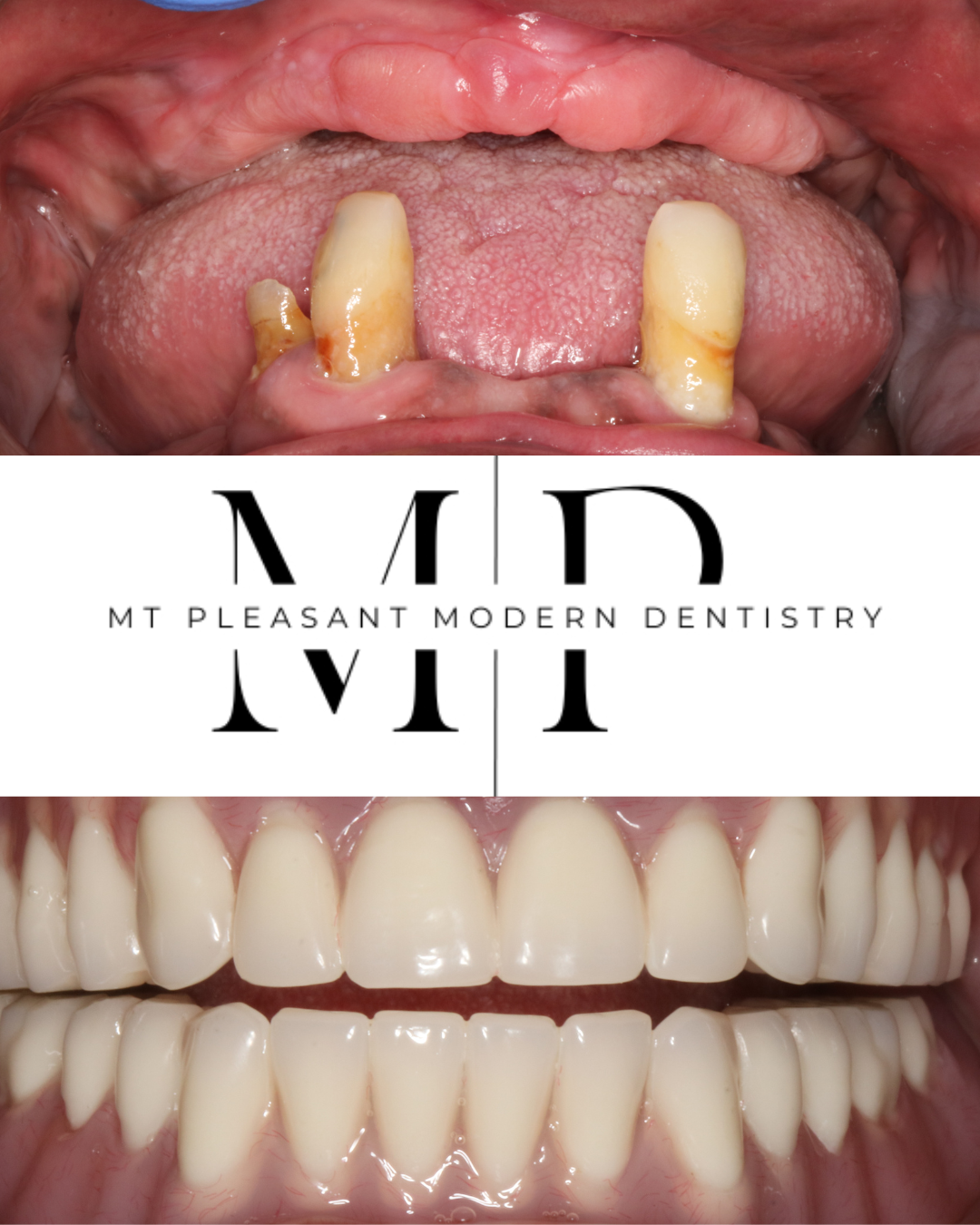 Model of upper and lower dentures, with dental implants attached to the upper arch.
