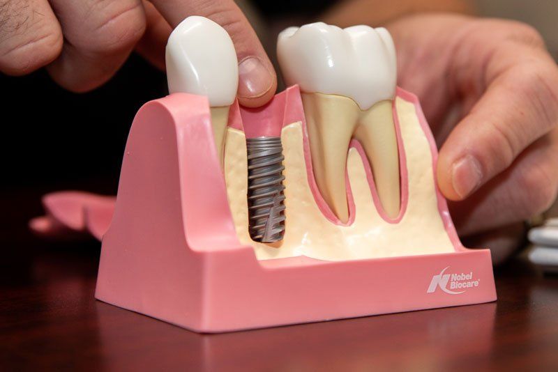 Hand pointing to a model of a dental implant, showing its screw and artificial tooth on a pink gum base.