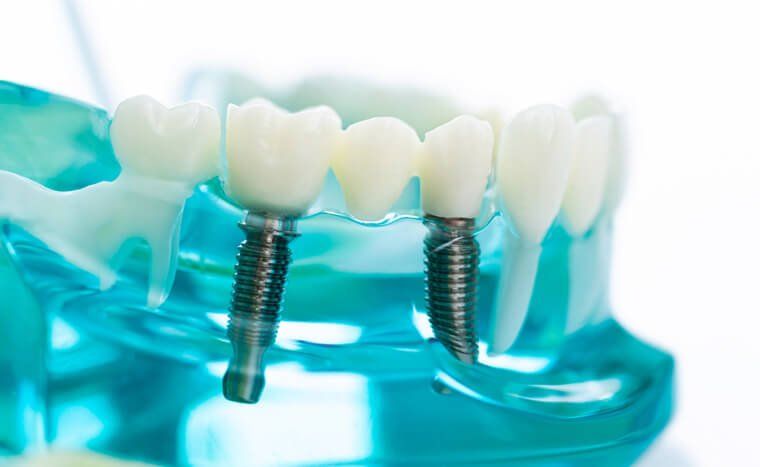 Model of dental implants in a blue plastic jaw; two implants supporting a three-tooth bridge.