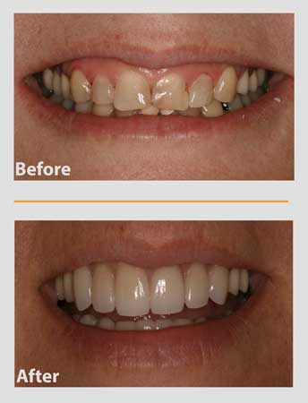 Before-and-after of a person's teeth. Yellowed, crooked teeth replaced with straight, white teeth.