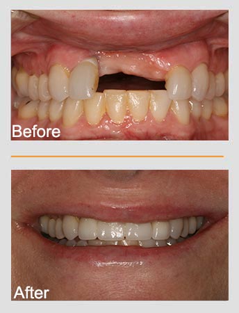 Dental work before and after: upper teeth with missing tooth replaced, resulting in a full, bright smile.