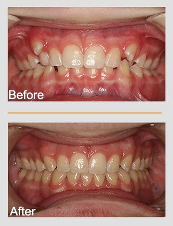 Before and after comparison of teeth. Upper teeth are crooked before, aligned after.
