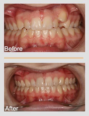 Comparison of teeth alignment, before and after orthodontic treatment.