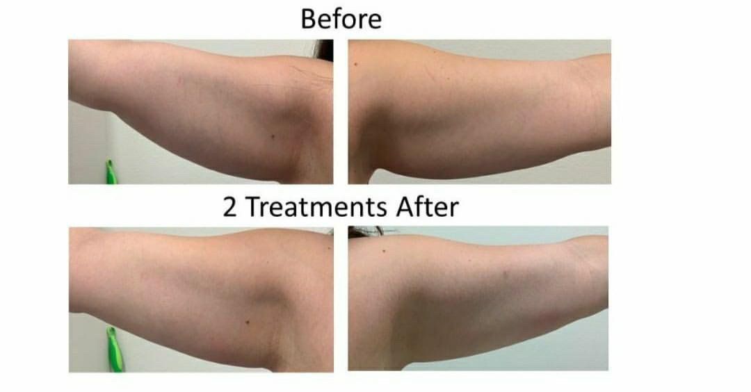 Before and after arm body sculpting treatment