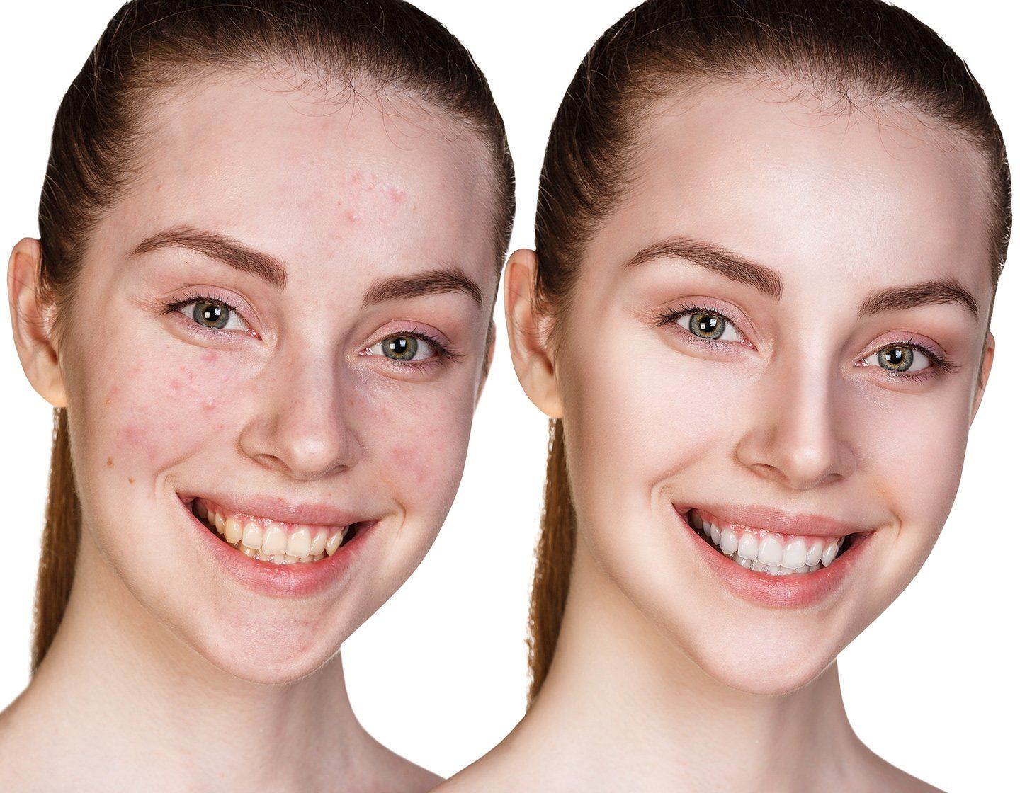 ACNE