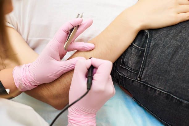 A woman is getting hair removed from her arm by an electrologist using an electrolyzer machine and tweezers