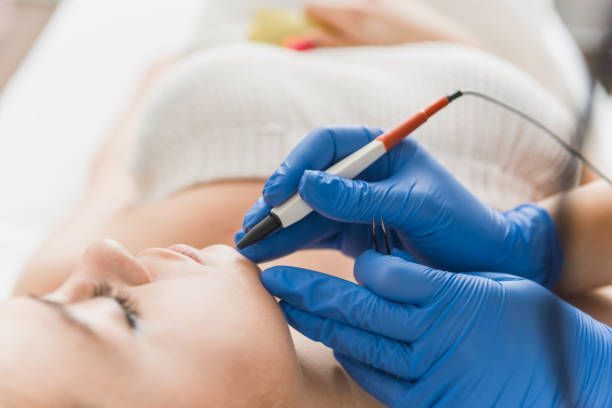 A woman is getting facial hair removed by an electrolysis wearing blue gloves