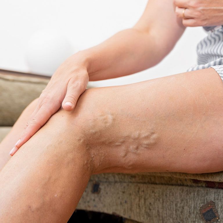 Endovenous Laser Therapy Procedure