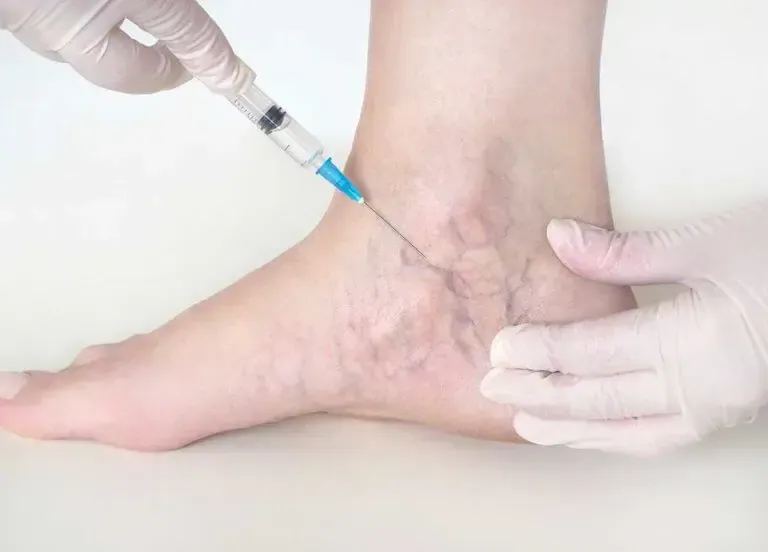 Endovenous Laser Therapy Procedure