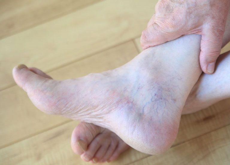 Endovenous Laser Therapy Procedure