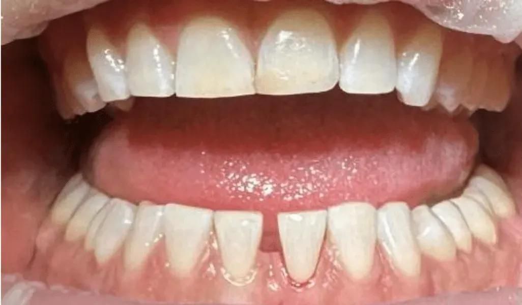 A close-up view of a person's mouth showing top and bottom teeth, with a visible gap between the lower front teeth.