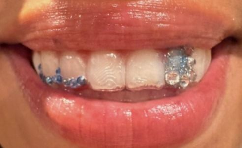 Close-up of a person's smile, showing teeth with decorative blue and clear braces.