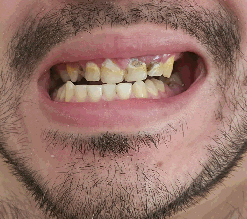 Man's mouth with severely decayed and discolored teeth, showing poor dental health.