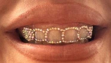 Mouth with diamond-encrusted grill covering upper teeth, reflecting various colors, against pale skin.