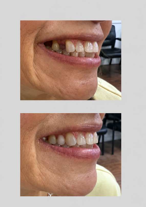 Close-up side view of a smiling mouth, showing teeth before and after dental work.