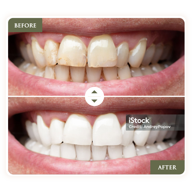 Side-by-side comparison: stained teeth 