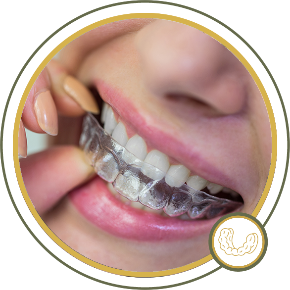 Person inserting a clear aligner over teeth.