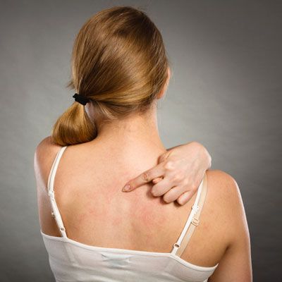 Dr. José Refugio Enríquez Salazar, síntomas, causas, urticaria, ronchas, comezón, enrojecimiento, pi