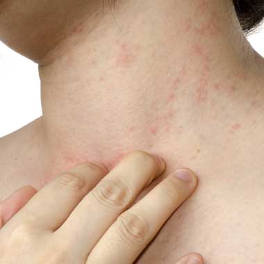 dermatitis