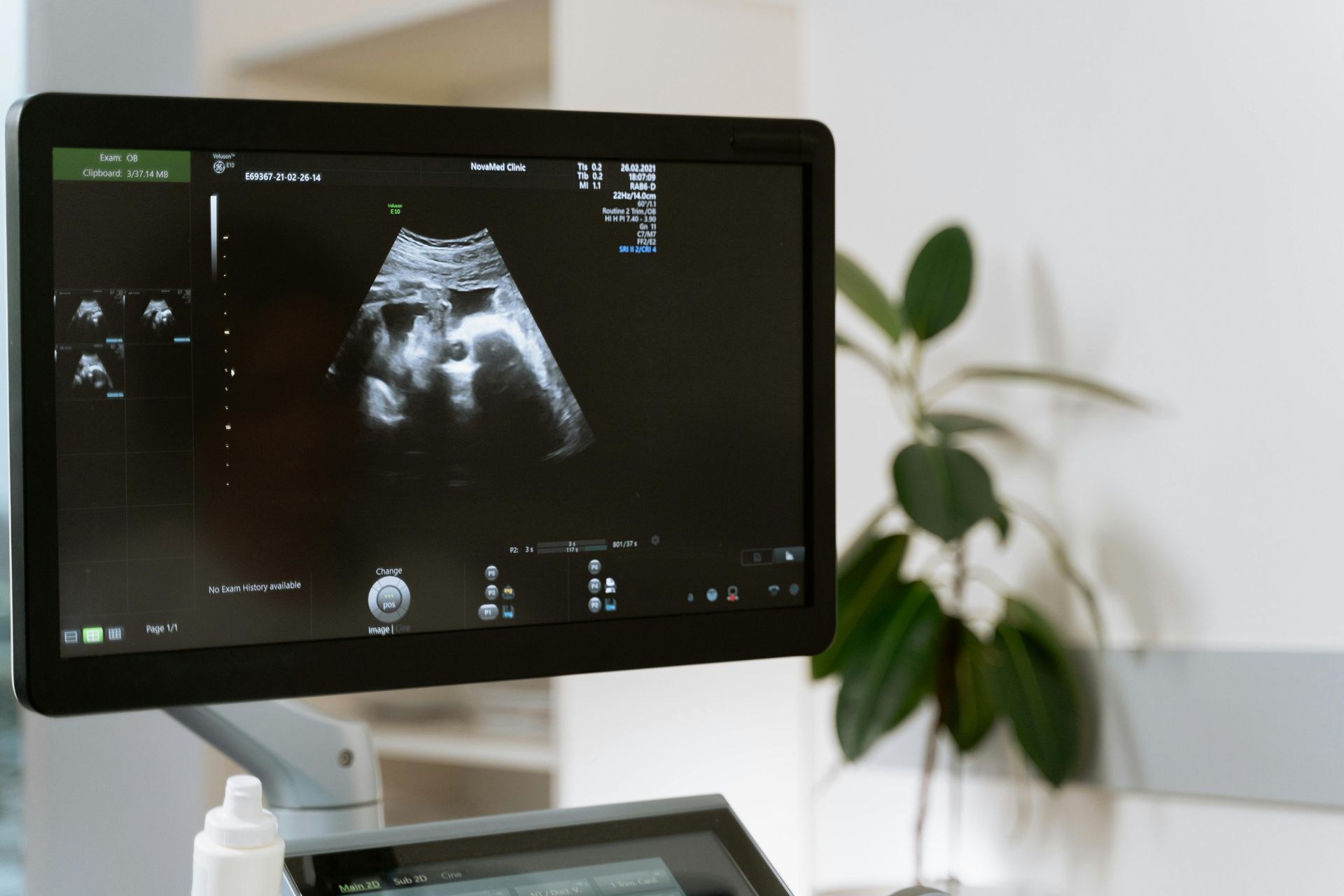 Un monitor de computadora muestra una ecografía de una mujer embarazada.