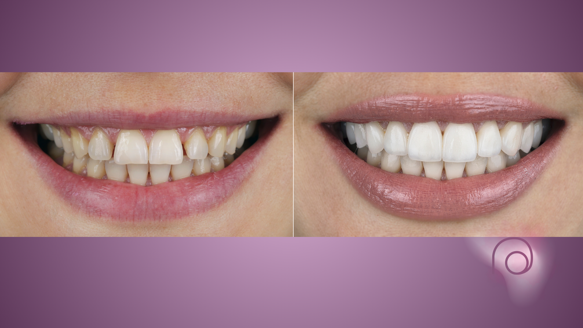 Before-and-after comparison of a smile showing teeth whitening and alignment improvements.