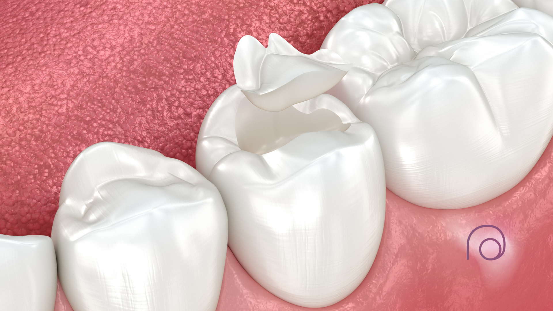 A close up of a tooth with a filling in it.