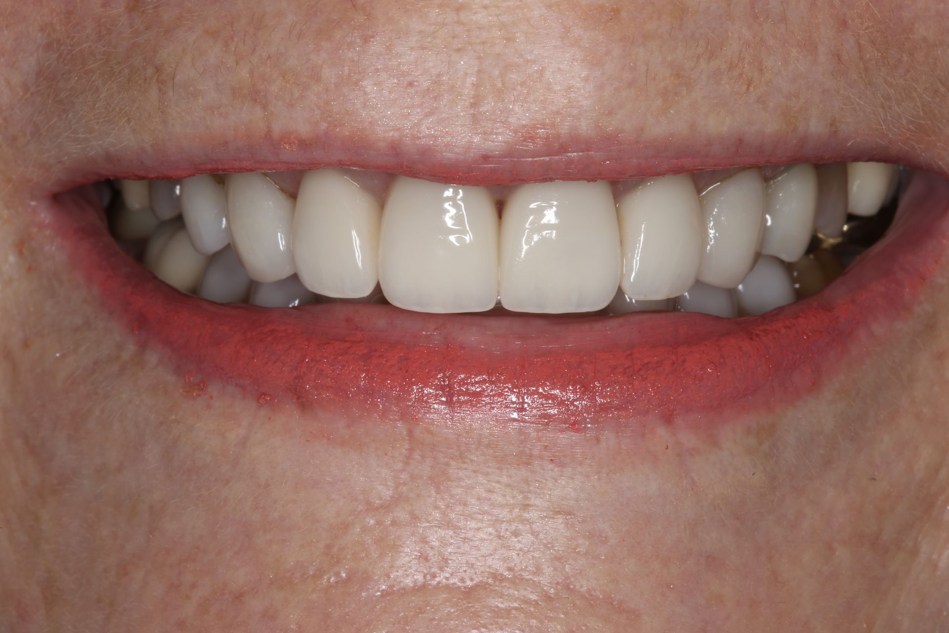 A close-up of a person's mouth showing a row of white, well-aligned teeth while smiling.