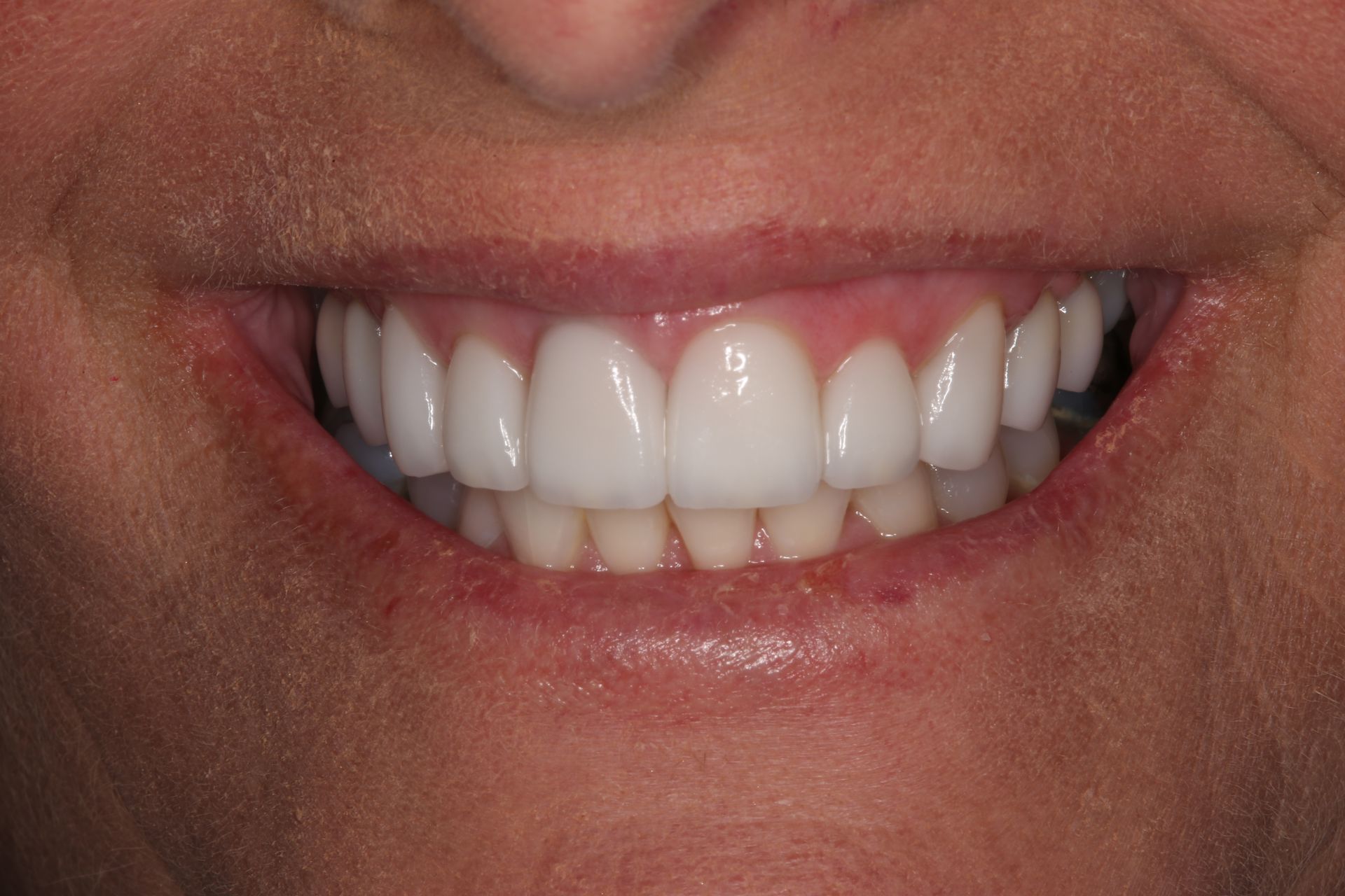 A close-up of a person's mouth displaying straight, bright white teeth.