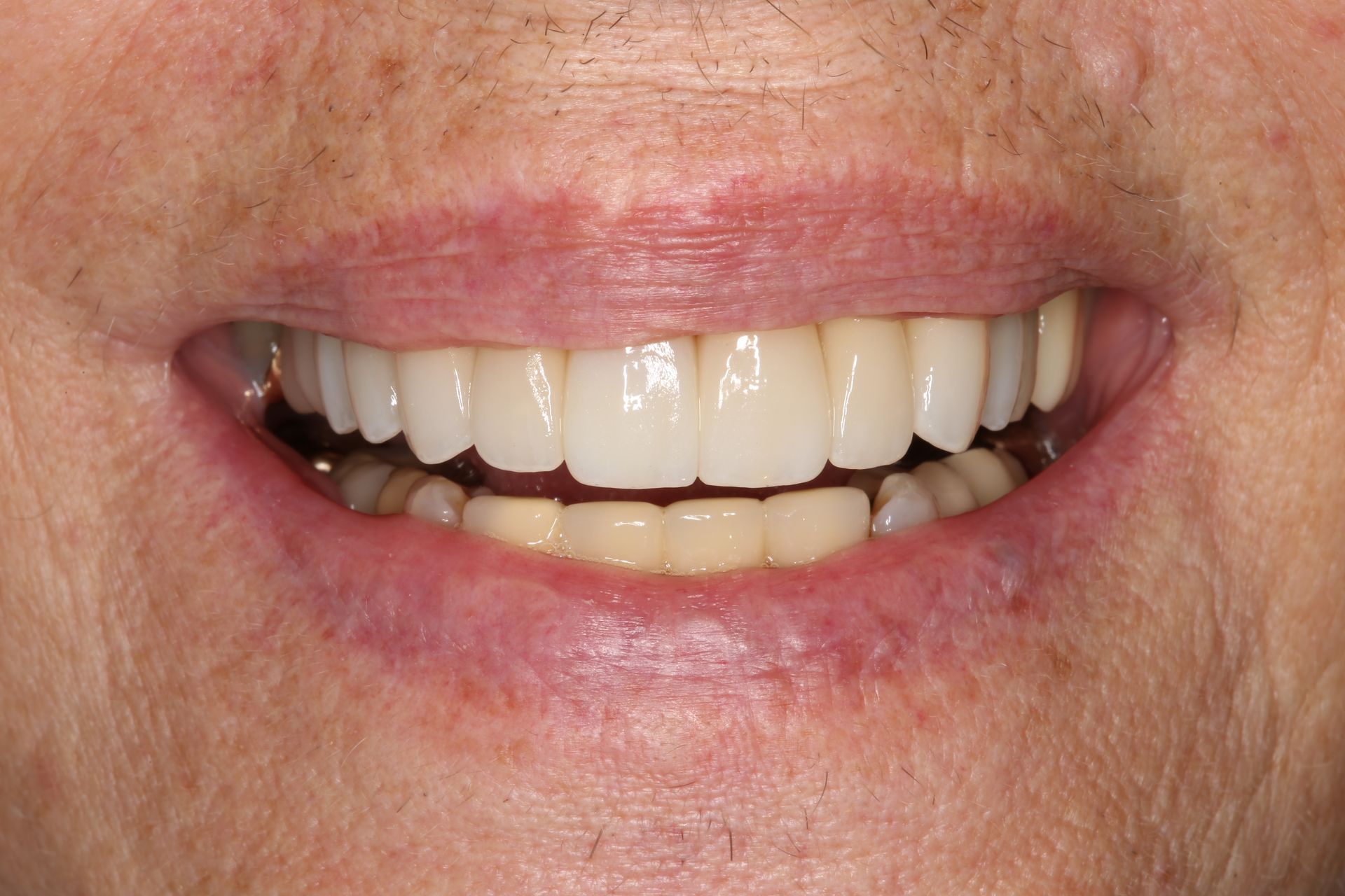 A close-up of a person smiling, showcasing a full set of bright, white upper and lower dental crowns or veneers.