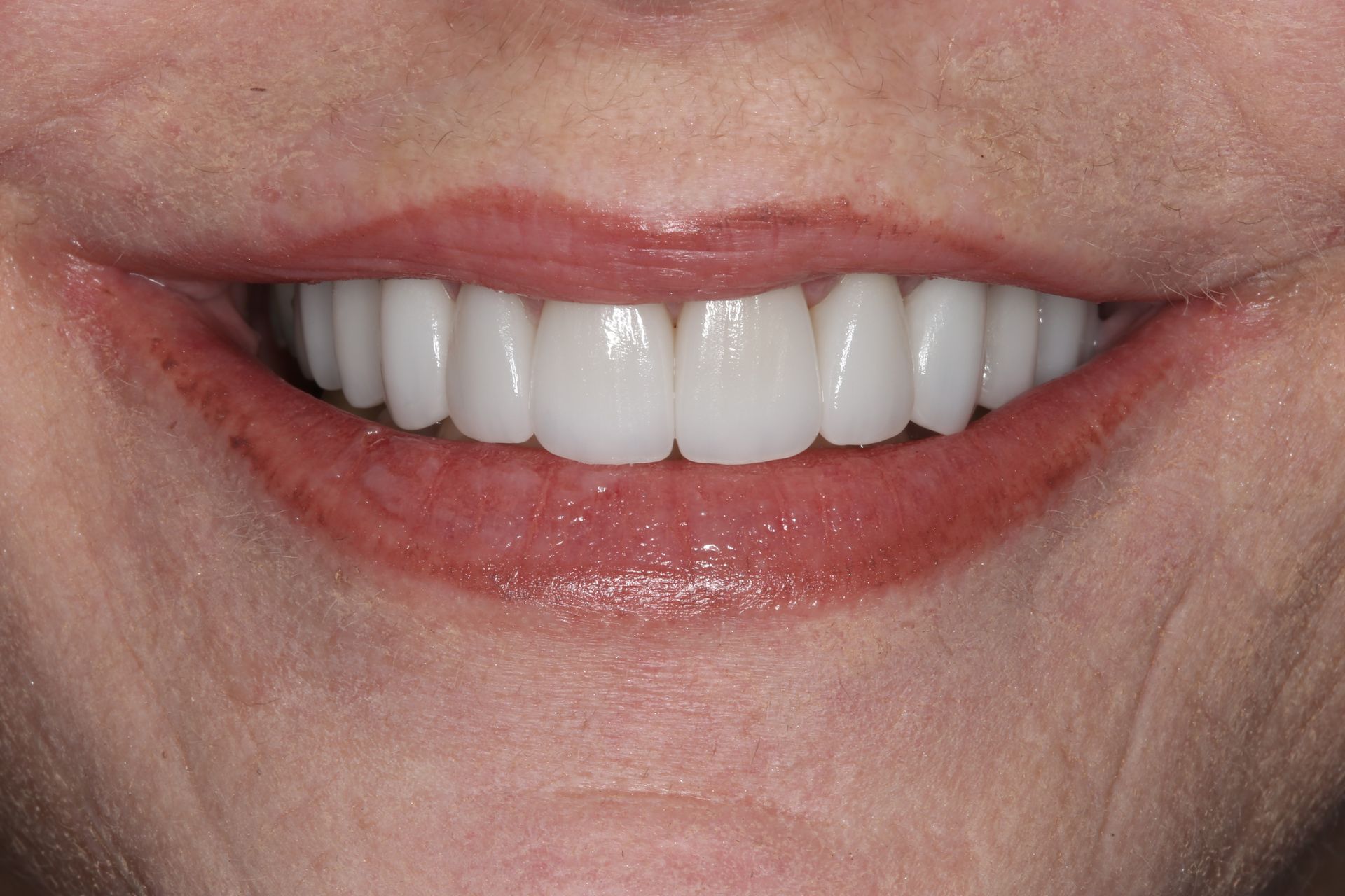 A close-up of a person's mouth showing a row of bright white, uniform teeth while smiling.
