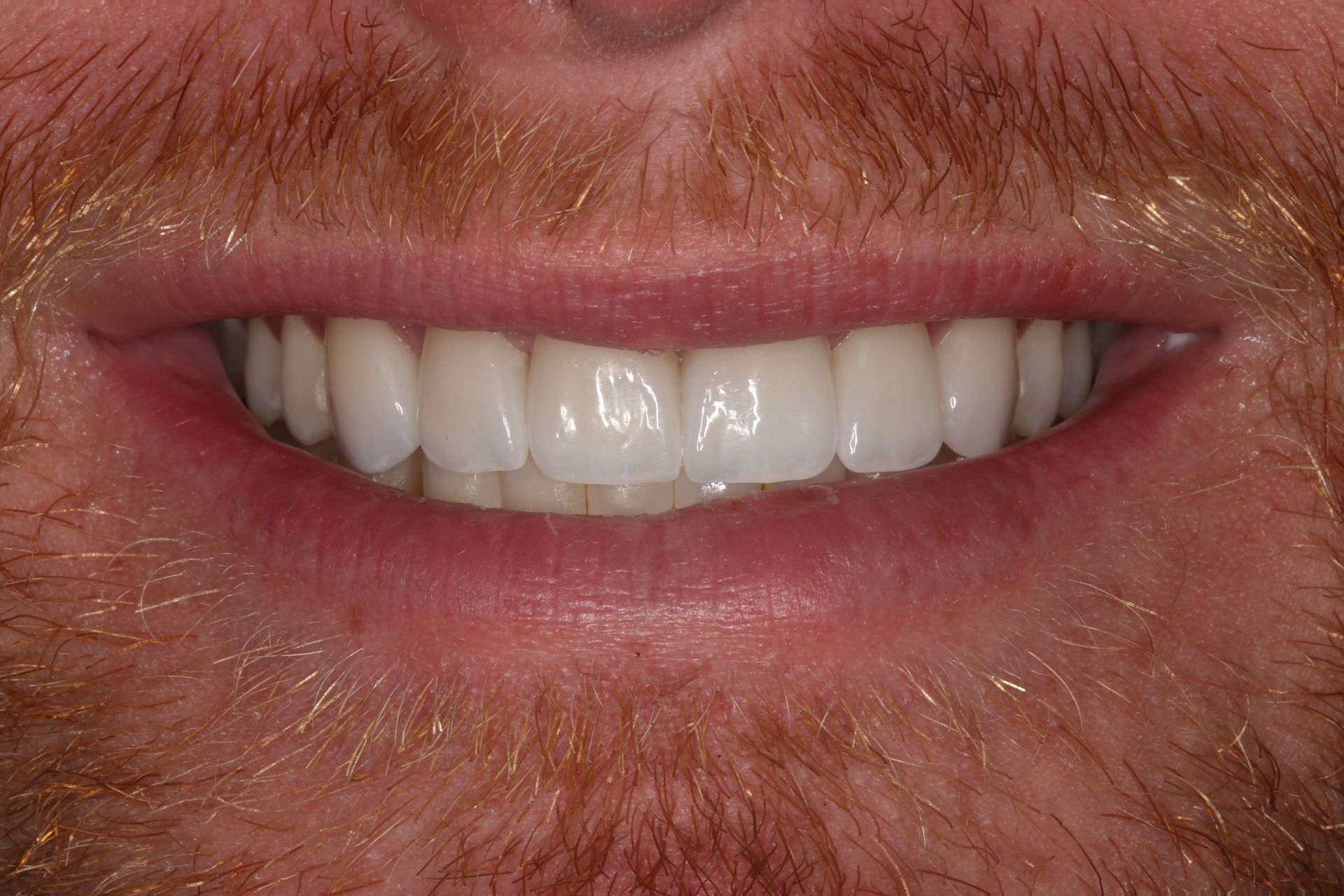 A close-up of a person smiling, showcasing straight, white teeth and a mustache with red-toned facial hair.