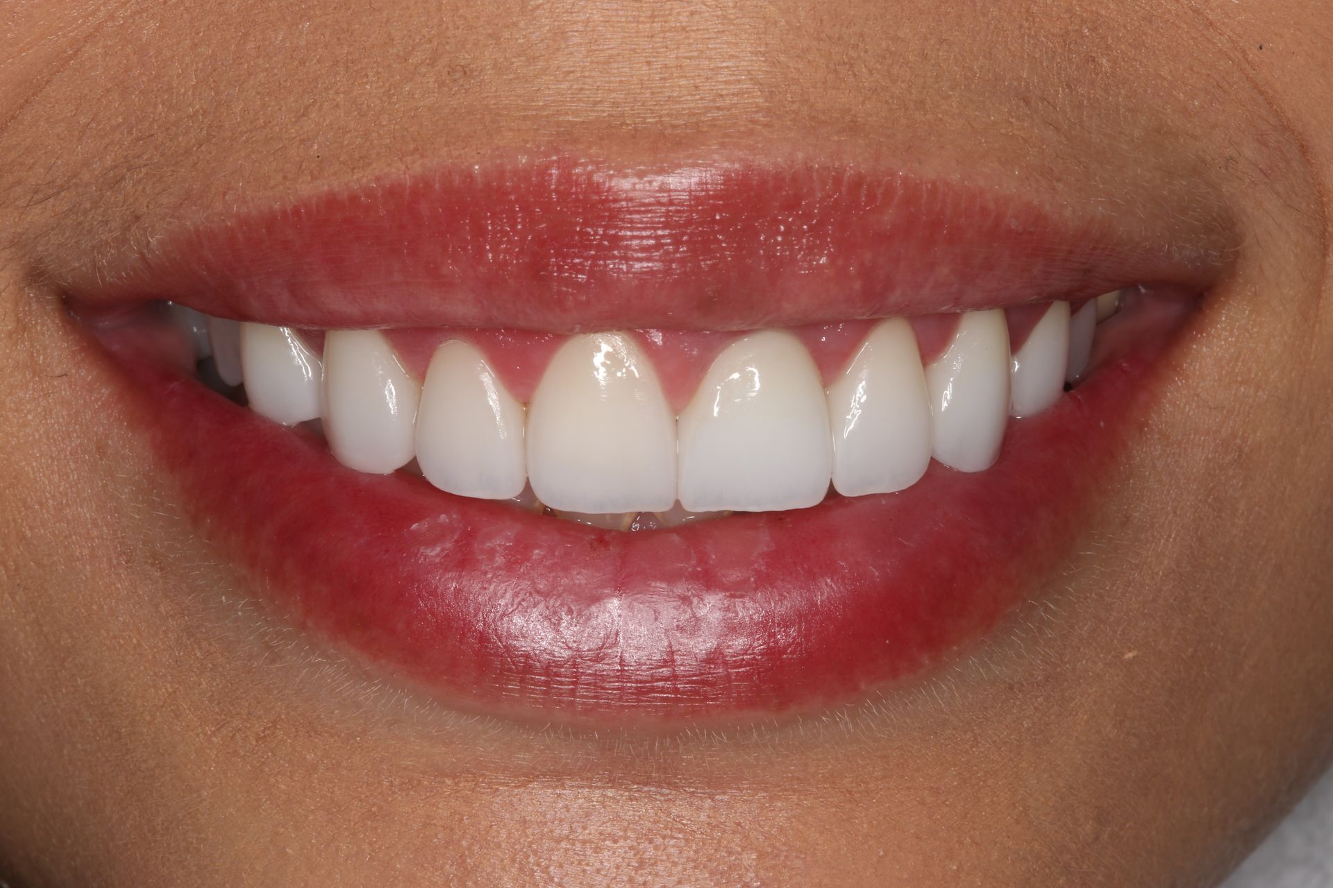 A close-up view of a smiling mouth displaying healthy, white, and well-aligned teeth.