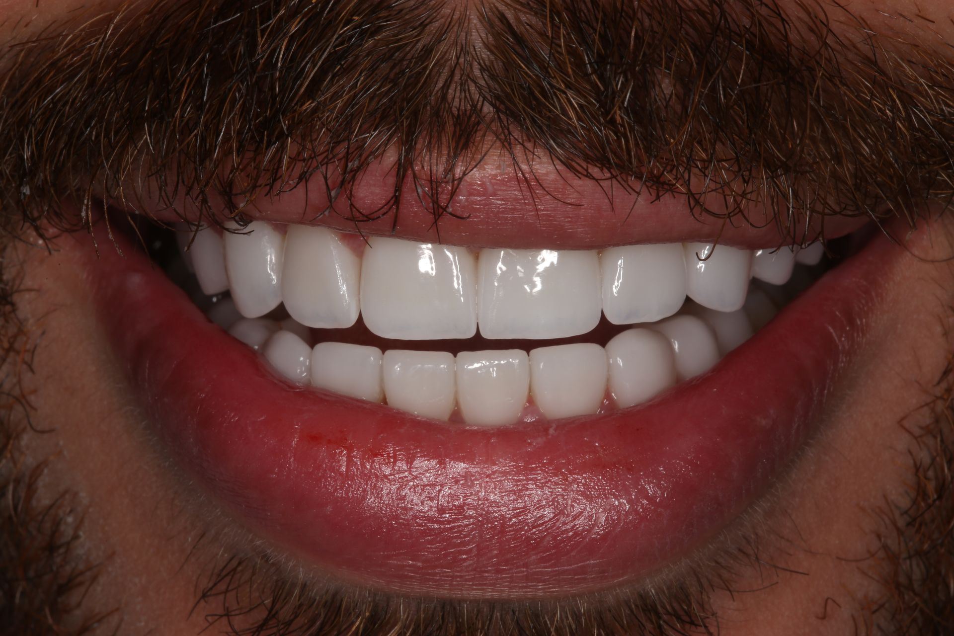Close-up of a person with a mustache smiling, showing straight, bright white teeth.