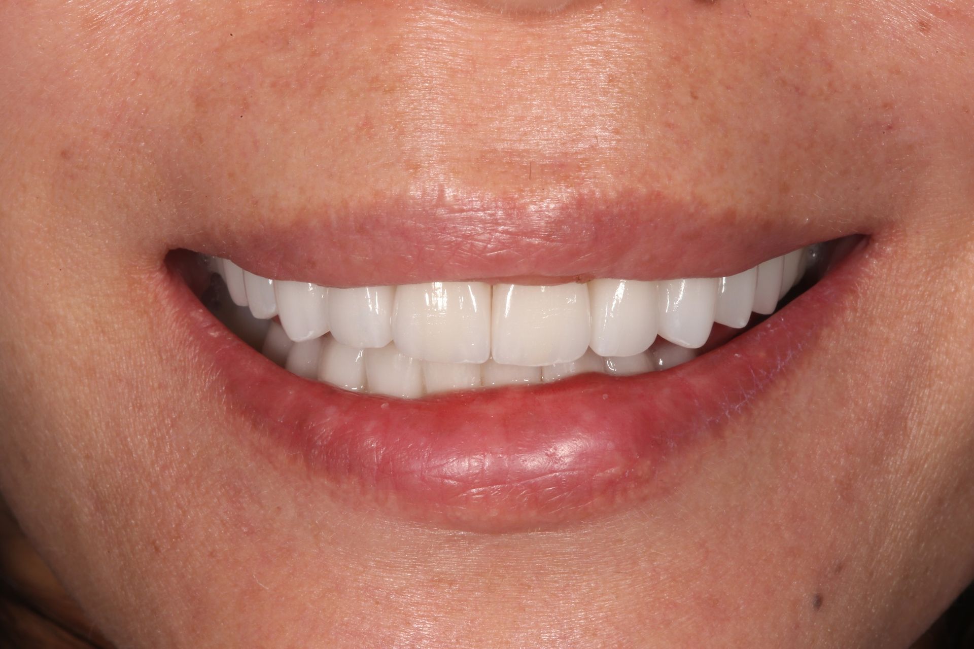 Close-up of a person smiling, showcasing straight, white teeth and dental veneers.